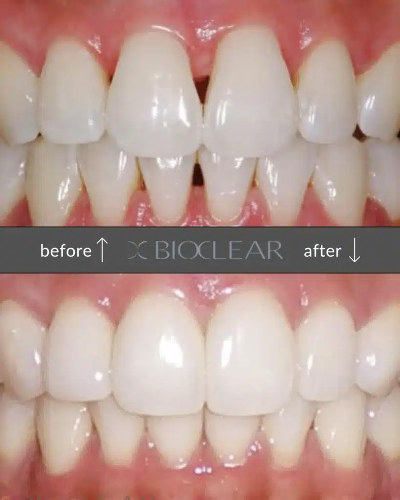 before and after bioclear bonding treatment for restoration of black triangles