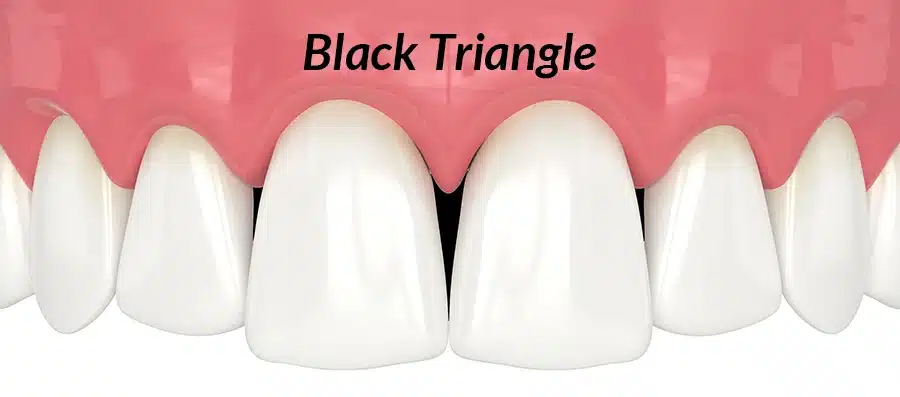 healthy smile with a black triangle between the gum line and front teeth