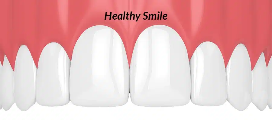 illustration of a healthy smile and gums (without a black triangle)